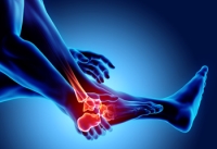 Types of Arthritis